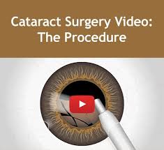 Cataract Surgery Video Cataract Surgery Cataract Eye Facts