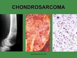 Image result for Chondrosarcoma