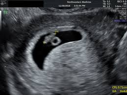 I'm having such a hard time getting into the local ob's so we are paying private at a 4d center to get a 2d dating scan. Diagnostic Ultrasound In The First Trimester Of Pregnancy Glowm