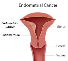 Uterine cancer is the most common cancer of the female reproductive tract. Endometrial Cancer Symptoms Babymed Com