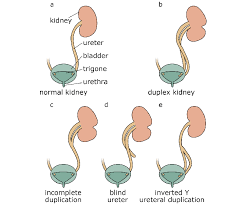 Duplex Kidney