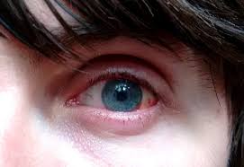 Pin On Corneal Transplant