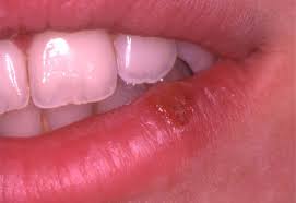 Gingivostomatitis is a combination of gingivitis and stomatitis, or an inflammation of the oral mucosa and gingiva. Herpes Simplex Virus Hsv Infection Of The Mouth European Association Of Oral Medicine
