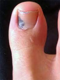 This keeps moisture away from your feet and allows any sweat to be absorbed by the sock. Black Toenail Skokie Il Foot Doctor