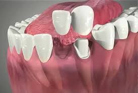 What Is A Cantilever Dental Bridge