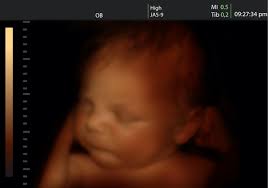 Das erste gerät mit über 25.000 schuss pro kartusche! á… 3d Ultraschall In Der Schwangerschaft Risiken Und Kosten