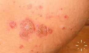 Image result for Impetigo