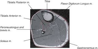 Typically sarcomas are aggressive and demonstrate low signal on t1wi and high signal on t2wi with intense and sometimes heterogeneous contrast enhancement 2. Use Of Mri For Volume Estimation Of Tibialis Posterior And Plantar Intrinsic Foot Muscles In Healthy And Chronic Plantar Fasciitis Limbs Sciencedirect