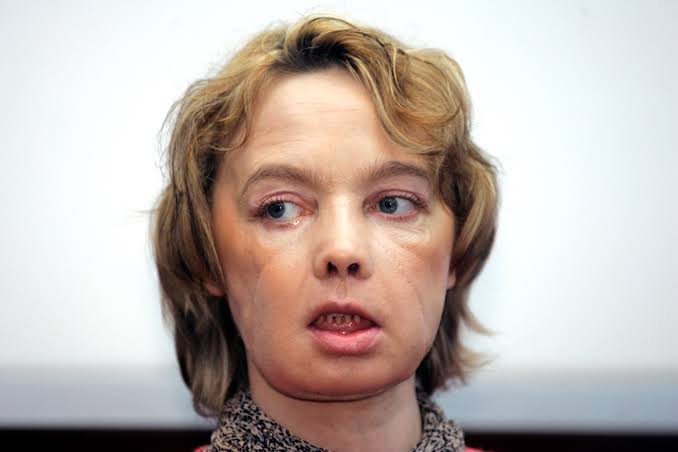 First Face Transplant Patient, A French Woman, Dies