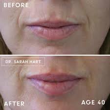 There are many botox and dermal filler training courses out. Discover The Secret To A Natural Look With Dermal Filler
