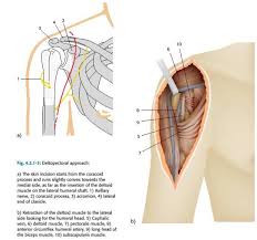 The long head of biceps (lhb) is a very important tendon that travels through the shoulder joint (glenohumeral joint). Total Shoulder Arthroplasty Team Bone