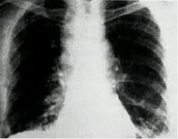 Anthrax is a rare, but serious, infectious disease caused by bacteria known as bacillus anthracis. ç‚­ç–½ãŒç–'ã‚ã‚Œã‚‹æ‚£è€…ã®è¨ºç™‚ã®ãƒã‚¤ãƒ³ãƒˆ ã«ã¤ã„ã¦