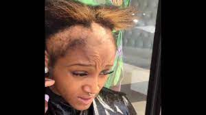 Girl Suffering From Severe Hairloss Due To Braids Sew Ins Quick Weaves Youtube