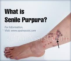 A laboratory investigation is only needed if a diagnosis is not readily apparent. What Is Senile Purpura How Is It Treated Causes Symptoms Natural Remedies For Senile Purpura