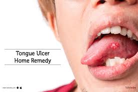 Image result for mouth ulcer on tongue)