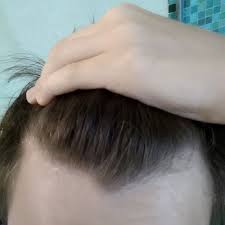 Maybe you would like to learn more about one of these? Is My Hairline Receding 15 Male Help Hairlosstalk Forums
