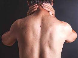 Oct 01, 2020 · the swelling from meningitis typically triggers signs and symptoms such as headache, fever and a stiff neck. Meningitis Pictures Of Rash And Other Symptoms