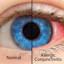 Image result for Allergic Conjunctivitis