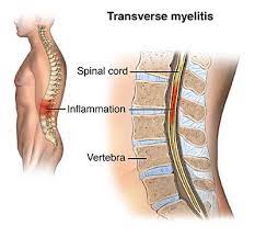 The highest number of new cases in a given year occur between age 10 and 19 and between age 30 and 39 years. Transverse Myelitis