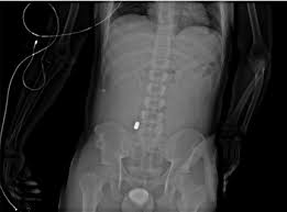Image result for Intravenous Pyelogram