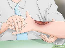 How To Heal Burns Fast (With Pictures) - Wikihow