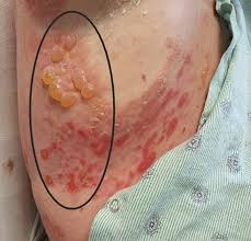 Image result for Pemphigoid