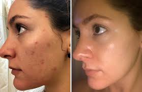 Acne is a common skin condition that causes pimples, whiteheads,  blackheads, and sometimes cysts. It mainly affects teenagers, but it can  also affect adults.