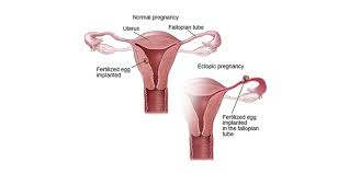 Check spelling or type a new query. Ectopic Pregnancy Treatment Surgery Hospital In India Rg Hospital