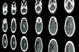 Não é possível afirmar que o tumor cerebral tem cura, pois cada caso possui suas características particulares. Accidente Cerebrovascular International Reeve Foundation