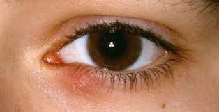 Hat irgendjemand erfahrungen mit ähnlichen. Gerstenkorn Hagelkorn Auge Online