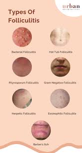 Image result for folliculitis symptoms