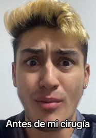 AMO AMO AMO (tenía muchos borradores de transiciones jsjsjsjs) #rinoplastia  #cirugia #rinoplasty #toxicosteña