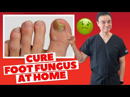 Foot Fungus Home Remedies That REALLY Work!