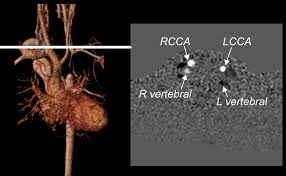 Fetal rsa plays an important role in. Number 18 11 Late Diagnosis Of Interrupted Aortic Arch In A Child With Kabuki Syndrome Society For Cardiovascular Magnetic Resonance