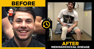At 23, Seb lost 7 fingers, his right leg and left foot from meningococcal  disease. Get vaccinated. Young people are at higher risk. Find out more:  https://www.health.nsw.gov.au/infectious/meningococcal/Pages/default.aspx