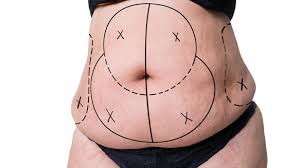 Will my insurance help cover the cost of surgery? Will Medicare Cover My Tummy Tuck Coco Ruby Plastic Surgery