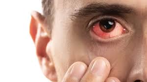 Image result for Scleritis