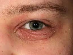Blepharitis Dermnet Nz In 2020 Dry Skin Around Eyes Swollen Eyelids Remedy Eyelid Dermatitis