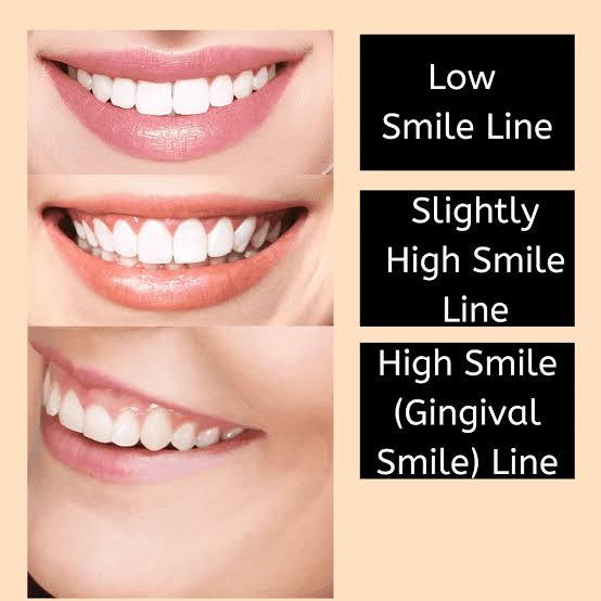What is the Gingival Smile Line?
