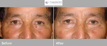 In the united states, it's estimated that doctors diagnose over 100,000 new skin cancer cases each year. Eyelid Skin Cancer Before And After Photos Taban Md