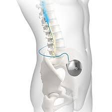 Image result for Intrathecal Pump
