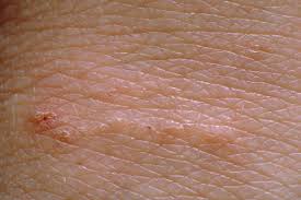 Image result for scabies symptoms
