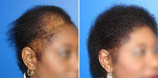 The hair loss clinic has analyzed the reasons for hair loss for america's most prominent ethnicity traction alopecia is also noticed in african american men who take on similar hairstyles like weaves. Pin On Alopecia