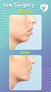 Jaw Surgery Before And After In 2021 Jaw Surgery Surgery Plastic Surgery