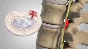 The intervertebral discs act as shock absorbers between the bones of the spine and allows the feline a great deal of movement. Herniated Disc Patient Education Youtube