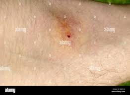 Image result for infected tick bite