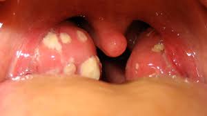 However, adults are not immune to it. Tonsillitis Vs Strep Throat How To Tell The Difference