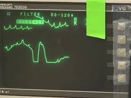 Harrison's principles of internal medicine. Normothermic Cardiac Arrest And Cardiopulmonary Resuscitation A Mouse Model Of Ischemia Reperfusion Injury Protocol