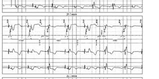 The pacemaker or pulse generator) and a lead or leads. Dual Chamber Ddi Mode Cardiocases