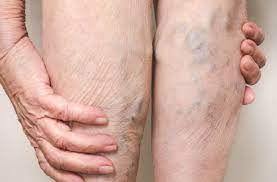 Maybe you would like to learn more about one of these? Why Big Blue Varicose Veins Raise A Red Flag Health Essentials From Cleveland Clinic